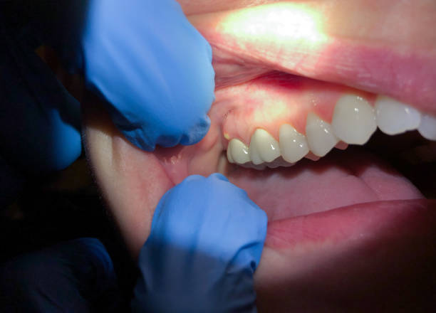 Best Emergency Dentist for Special Needs Patients in Bellows Falls, VT