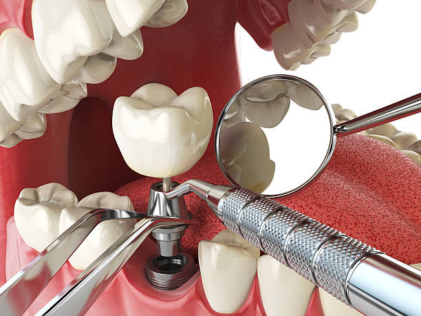 Best Emergency Dental Care for Abscessed Tooth in Bellows Falls, VT